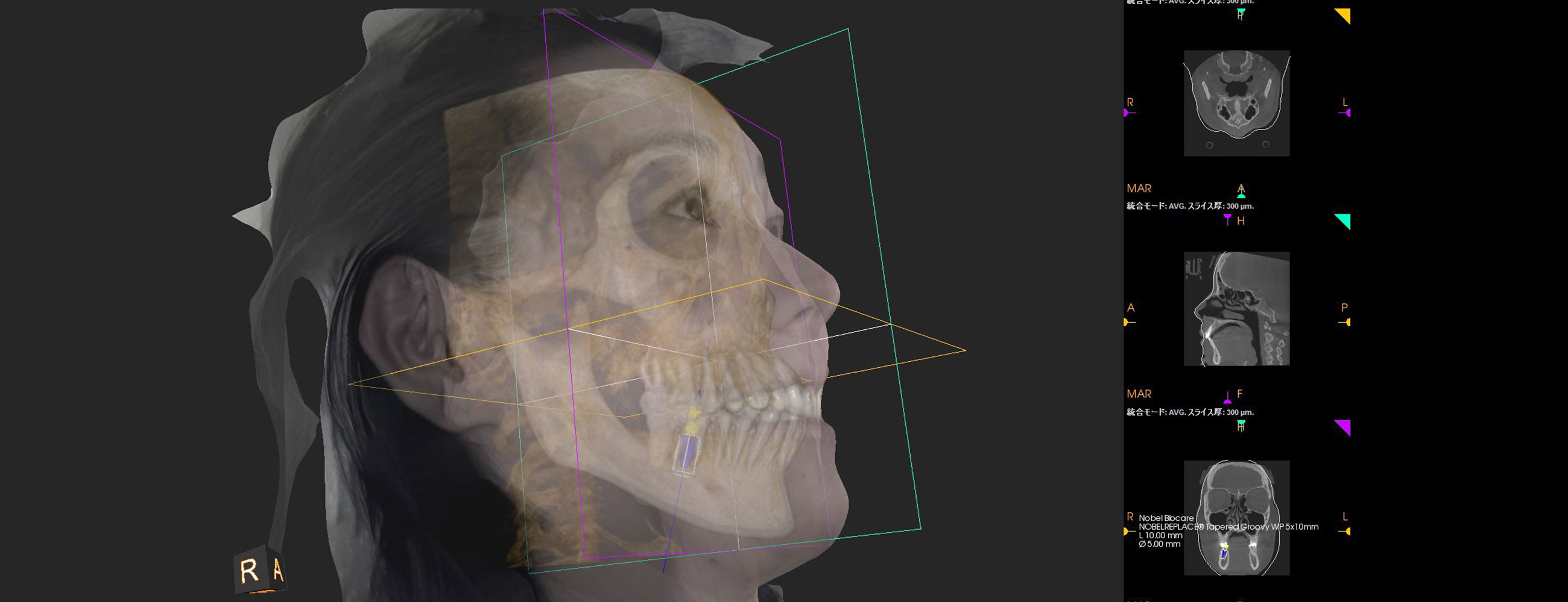3Dフェイススキャンを使った事前診断による、わかりやすいインプラント治療