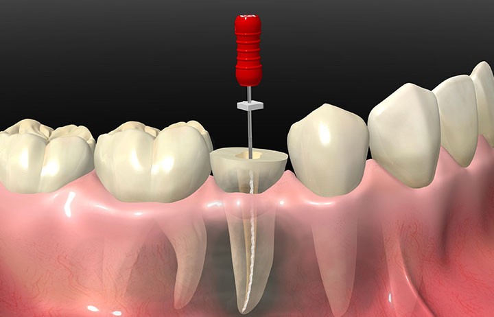根管治療