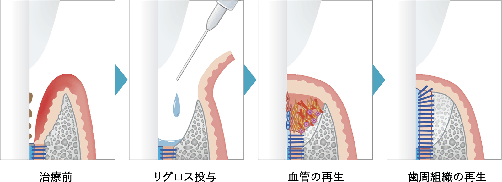 歯周組織再生剤による歯周組織の再生