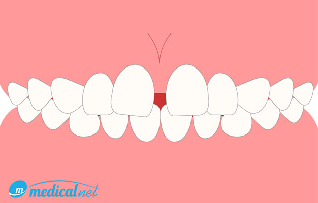 空隙歯列（正中離開、すきっ歯）