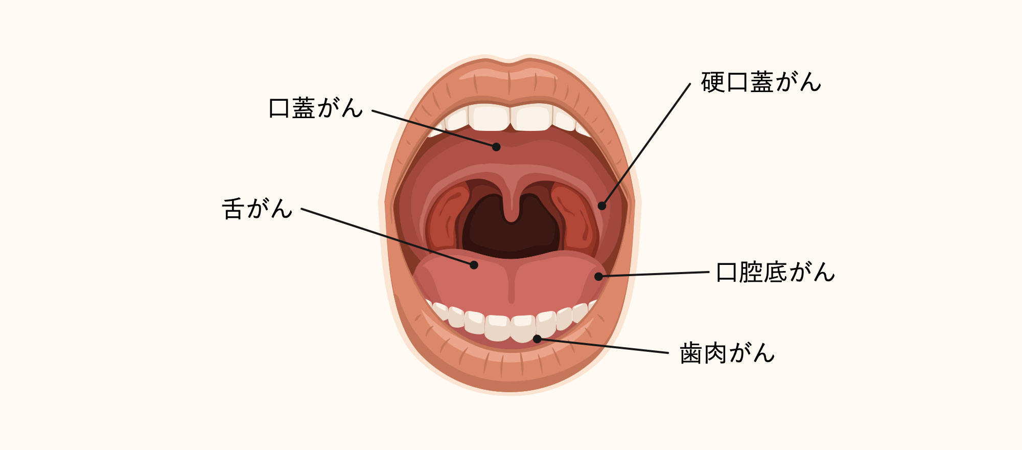 口腔がんとは