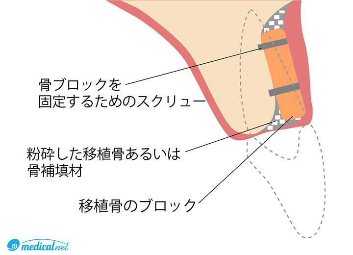 ボーングラフト（骨移植法）