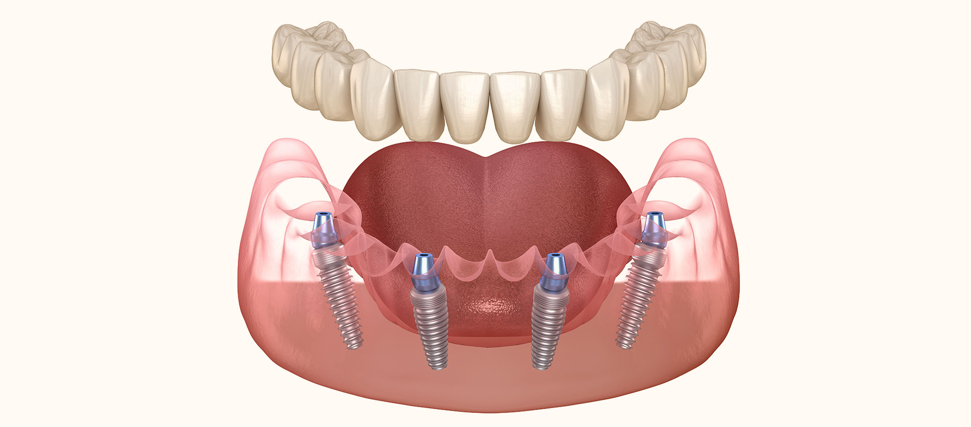 All-on-4（最少4本のインプラントを用いて固定式補綴物を支える無歯顎修復）